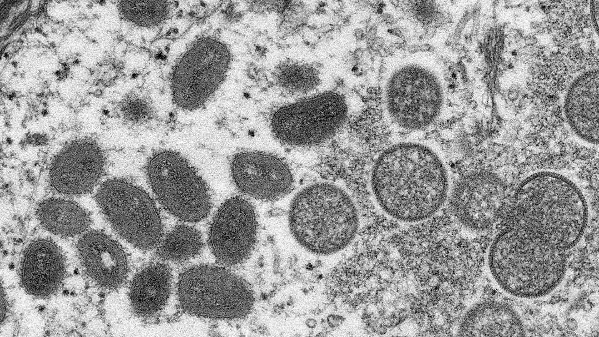 Microscopic view of monkeypox virus