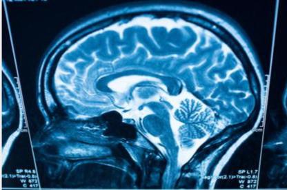 xray image of brain inside skull from the side
