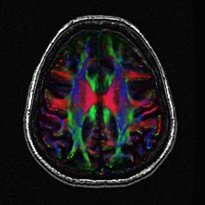 Alzheimer's Disease graphic