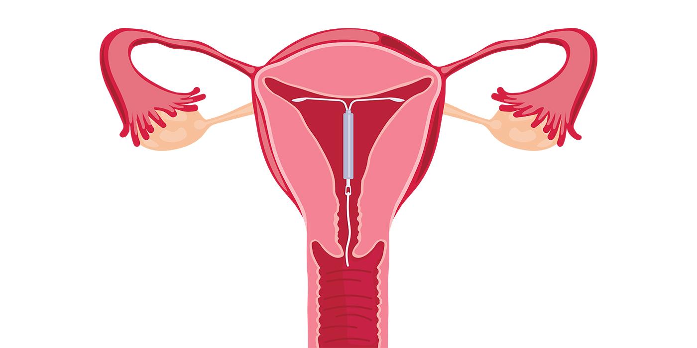 Illustration of a uterus with IUD inside