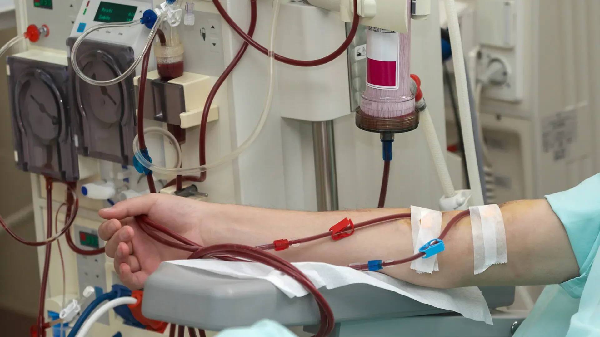 blood being drawn from arm into kidney testing machine